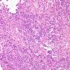 13B1 Lymphoma, primary CNS, B-cell Case 13) H&E 1.jpg