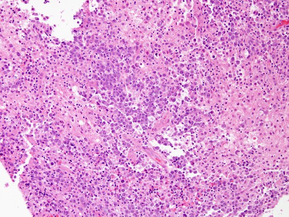 13B1 Lymphoma, primary CNS, B-cell Case 13) H&E 1.jpg