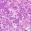 13B2 Lymphoma, primary CNS, B-cell (Case 13) H&E 3.jpg