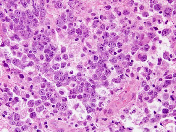 13B2 Lymphoma, primary CNS, B-cell (Case 13) H&E 3.jpg