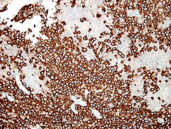 13C1 Lymphoma, primary CNS, B-cell (Case 13) CD20 2.jpg