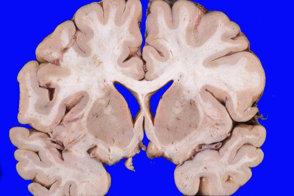 14A1 Lymphoma (Case 14) lesion