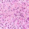 14B5 Lymphoma (Case 14) N6 Midbrain H&E 40X