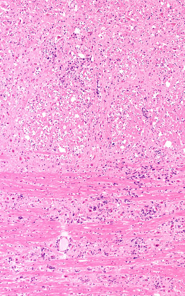 14B7 Lymphoma (Case 14) N7 H&E 10X