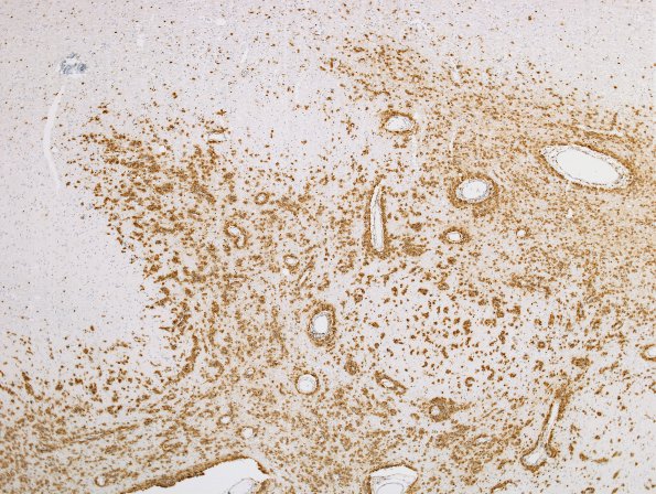 14C4 Lymphoma (Case 14) CD-20  2