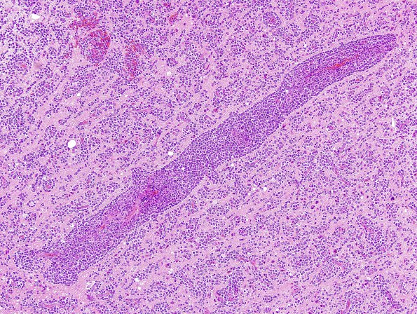 16B1 Lymphoma (Case 16) H&E 4