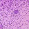 16B2 Lymphoma (Case 16) H&E 6