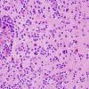 16B2 Lymphoma (Case 16) H&E 7