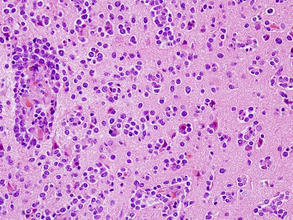 16B2 Lymphoma (Case 16) H&E 7