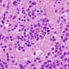 16B3 Lymphoma (Case 16) H&E 9