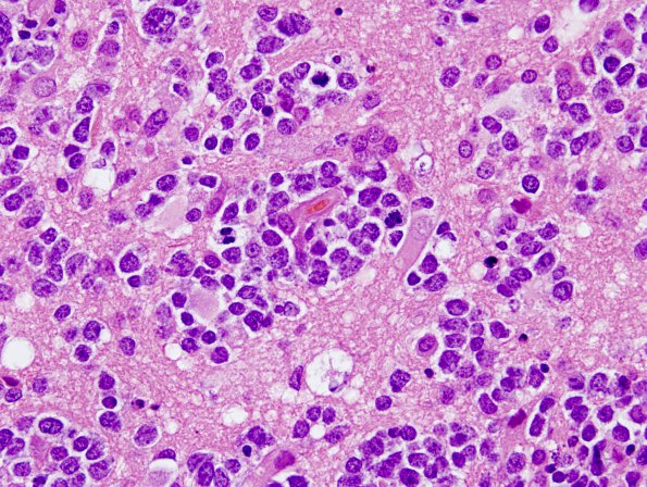 16B3 Lymphoma (Case 16) H&E 9