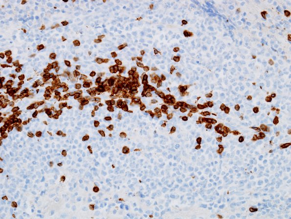 16C2 Lymphoma (Case 16) CD 3 40X