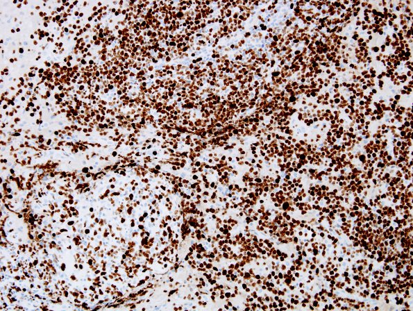 16D Lymphoma (Case 16) MIB 1