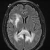 17A1 Lymphoma (Case 17) FLAIR - Copy