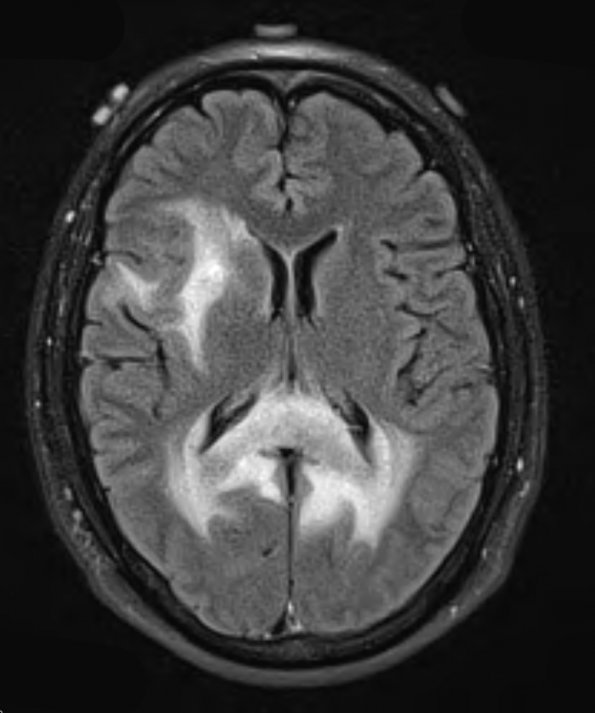 17A1 Lymphoma (Case 17) FLAIR - Copy