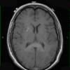 17A2 Lymphoma (Case 17) T1 2 - Copy