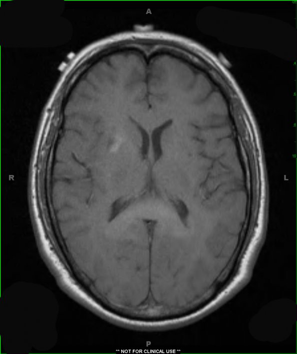 17A2 Lymphoma (Case 17) T1 2 - Copy