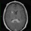 17A3 Lymphoma (Case 17) T1 W 3 copy