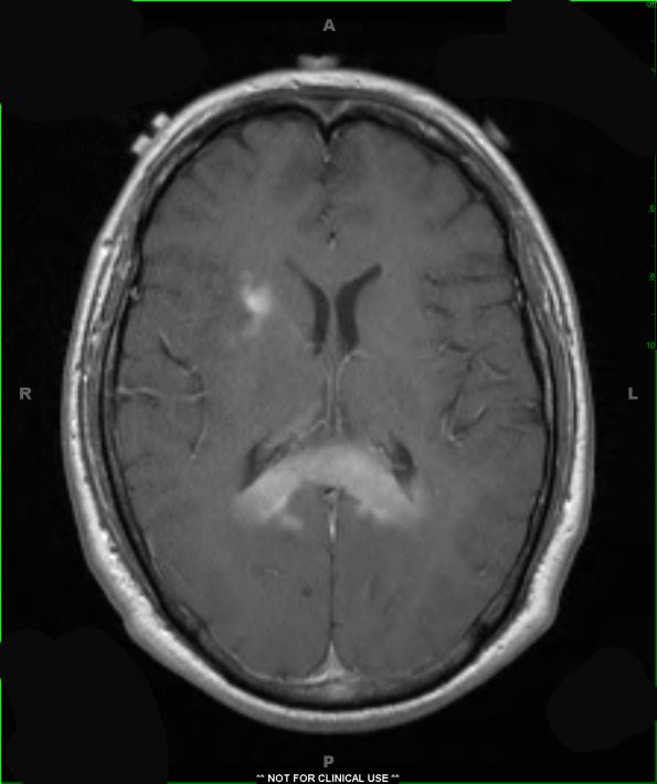 17A3 Lymphoma (Case 17) T1 W 3 copy