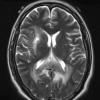 17A4 Lymphoma (Case 17) T2 W 2 - Copy