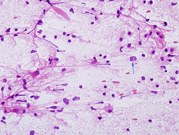 17B1 Lymphoma (Case 17) H&E smear 6 copy