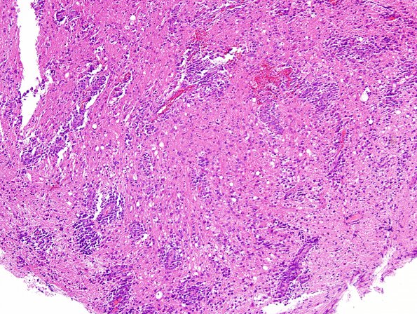 17B2 Lymphoma (Case 17) H&E 1