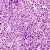 18A Lymphoma (Case 18) H&E 40X 2