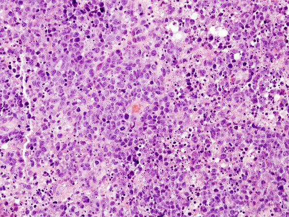 18A Lymphoma (Case 18) H&E 40X 2