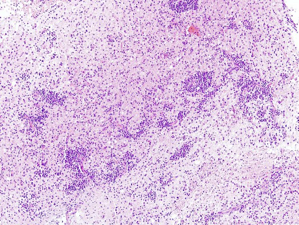 19A1 Lymphoma (Case 19) H&E 3