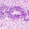 19A2 Lymphoma (Case 19) H&E 9