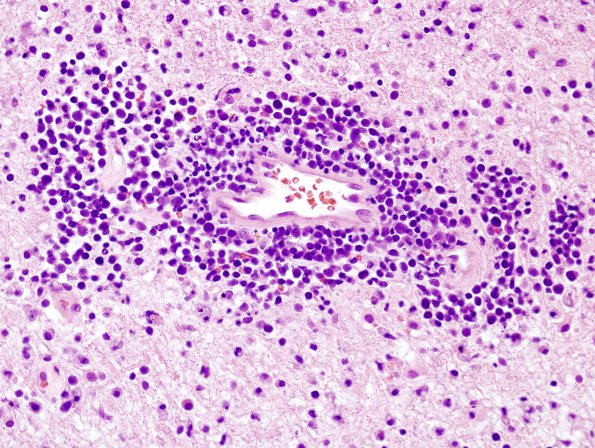 19A2 Lymphoma (Case 19) H&E 9