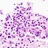 19A3 Lymphoma (Case 19) H&E 5