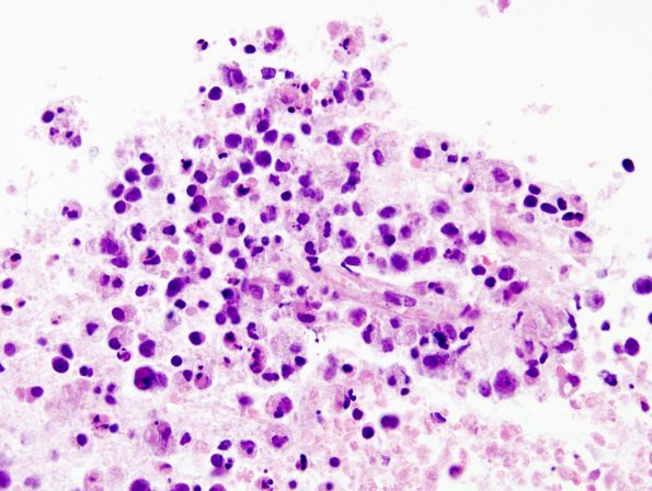 19A3 Lymphoma (Case 19) H&E 5