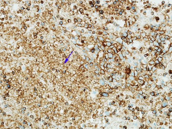 19B1 Lymphoma (Case 19) CD-20 (necrosis) 1 copy