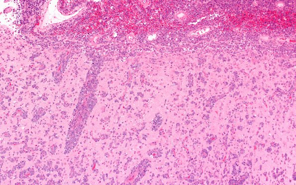 1A1 Lymphoma (Case 1) H&E 10X 2