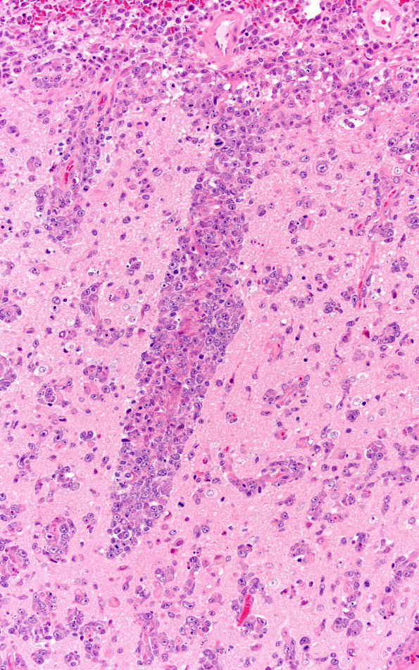 1A2 Lymphoma (Case 1) H&E 20XA