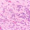 1A3 Lymphoma (Case 1) H&E 40X 2