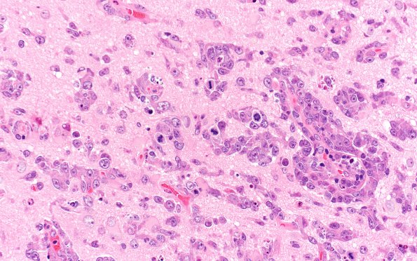 1A3 Lymphoma (Case 1) H&E 40X 2