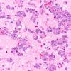 1A4 Lymphoma (Case 1) H&E 40X 3 copy