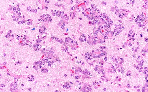 1A4 Lymphoma (Case 1) H&E 40X 3 copy