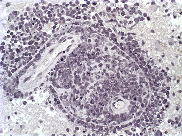 1B1 Lymphoma (Case 1) NEG 1