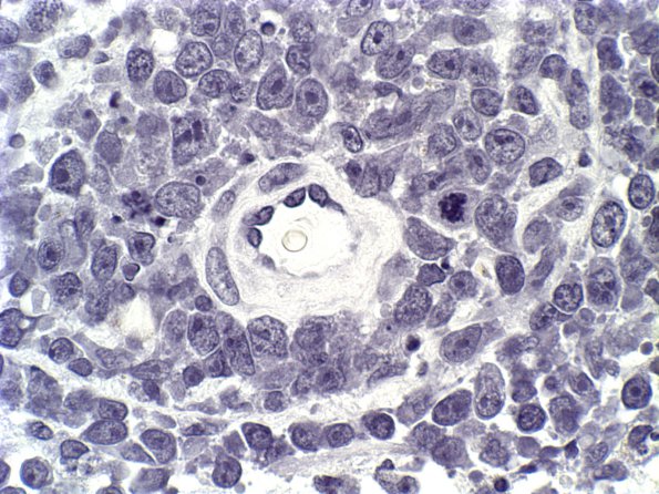 1B2 Lymphoma (Case 1) NEG 2