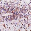 1C2 Lymphoma (Case 1) CD45 40X 2