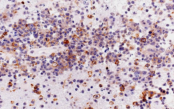 1C2 Lymphoma (Case 1) CD45 40X 2