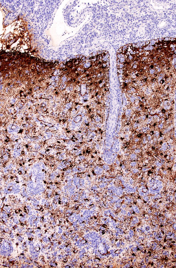 1D1 Lymphoma (Case 1) GFAP 10X