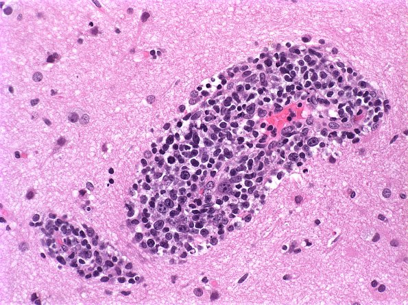 20A Lymphoma (Case 20) H&E 1