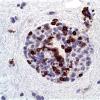 20B2 Lymphoma (Case 20) CD3