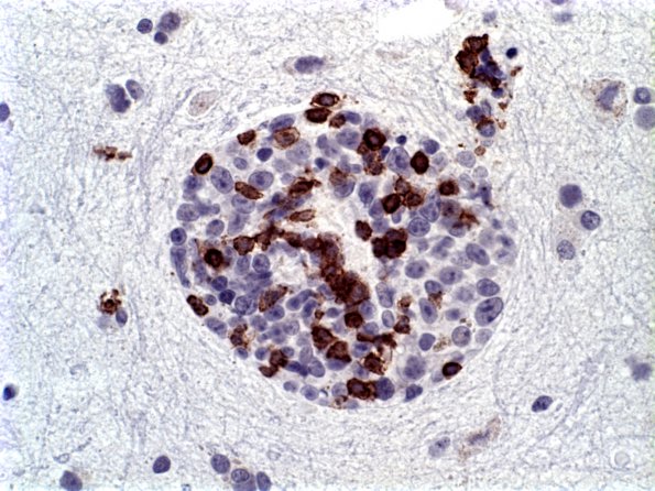 20B2 Lymphoma (Case 20) CD3