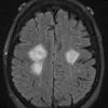 21A1 Lymphoma (Case 21) FLAIR 1 - Copy