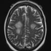 21A2 Lymphoma (Case 21) T2 W 1 - Copy